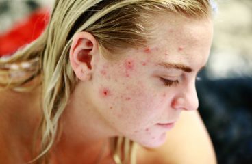 Can Female Enhancement Pills Cause Acne? How to Boost Desire and Keep Your Skin Health?